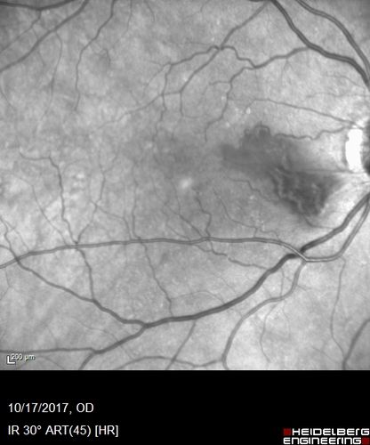 Cardiac Catheterization induced Cilioretinal Artery Occlusion - Paracentral Acute Middle Maculopathy
69 year old female with sudden vision loss on completing cardiac catheterization.  The SD OCT shows a PAMM lesion and the lesion looks gray on color imaging.  There is delayed filling of the cilioretinal artery.
