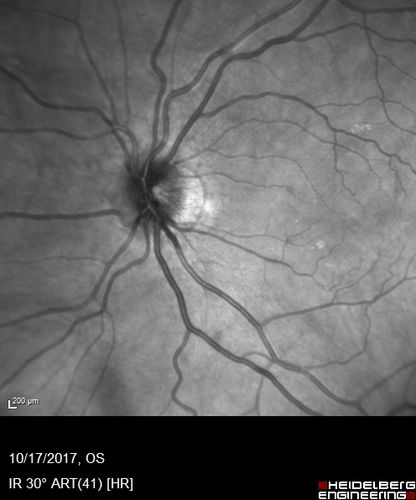 Cardiac Catheterization induced Cilioretinal Artery Occlusion - Paracentral Acute Middle Maculopathy
69 year old female with sudden vision loss on completing cardiac catheterization.  The SD OCT shows a PAMM lesion and the lesion looks gray on color imaging.  There is delayed filling of the cilioretinal artery.
