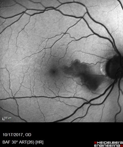 Cardiac Catheterization induced Cilioretinal Artery Occlusion - Paracentral Acute Middle Maculopathy
69 year old female with sudden vision loss on completing cardiac catheterization.  The SD OCT shows a PAMM lesion and the lesion looks gray on color imaging.  There is delayed filling of the cilioretinal artery.
