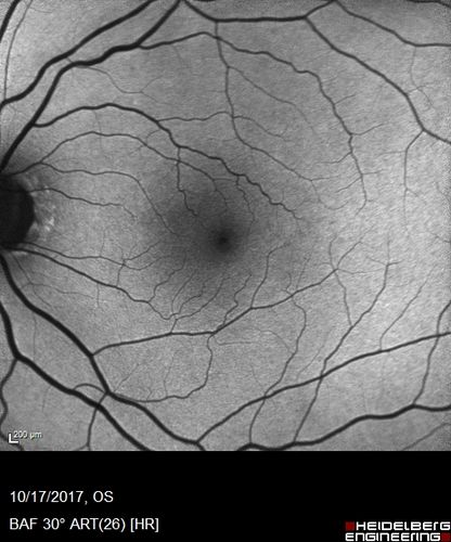 Cardiac Catheterization induced Cilioretinal Artery Occlusion - Paracentral Acute Middle Maculopathy
69 year old female with sudden vision loss on completing cardiac catheterization.  The SD OCT shows a PAMM lesion and the lesion looks gray on color imaging.  There is delayed filling of the cilioretinal artery.
