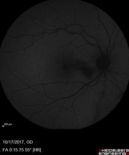 Cardiac Catheterization induced Cilioretinal Artery Occlusion - Paracentral Acute Middle Maculopathy
69 year old female with sudden vision loss on completing cardiac catheterization.  The SD OCT shows a PAMM lesion and the lesion looks gray on color imaging.  There is delayed filling of the cilioretinal artery.
