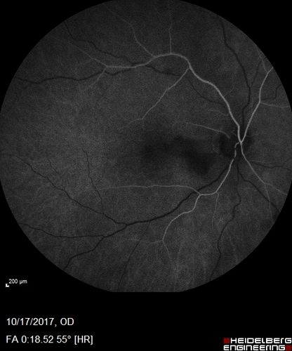 Cardiac Catheterization induced Cilioretinal Artery Occlusion - Paracentral Acute Middle Maculopathy
69 year old female with sudden vision loss on completing cardiac catheterization.  The SD OCT shows a PAMM lesion and the lesion looks gray on color imaging.  There is delayed filling of the cilioretinal artery.
