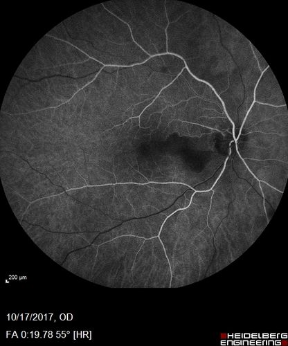 Cardiac Catheterization induced Cilioretinal Artery Occlusion - Paracentral Acute Middle Maculopathy
69 year old female with sudden vision loss on completing cardiac catheterization.  The SD OCT shows a PAMM lesion and the lesion looks gray on color imaging.  There is delayed filling of the cilioretinal artery.
