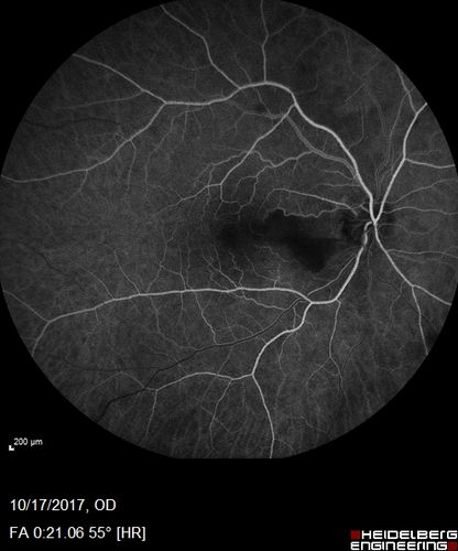 Cardiac Catheterization induced Cilioretinal Artery Occlusion - Paracentral Acute Middle Maculopathy
69 year old female with sudden vision loss on completing cardiac catheterization.  The SD OCT shows a PAMM lesion and the lesion looks gray on color imaging.  There is delayed filling of the cilioretinal artery.
