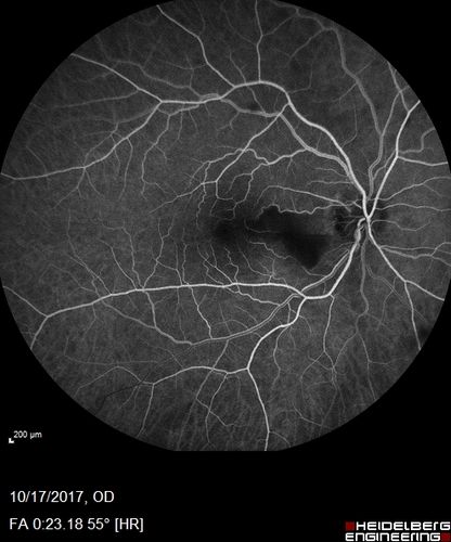 Cardiac Catheterization induced Cilioretinal Artery Occlusion - Paracentral Acute Middle Maculopathy
69 year old female with sudden vision loss on completing cardiac catheterization.  The SD OCT shows a PAMM lesion and the lesion looks gray on color imaging.  There is delayed filling of the cilioretinal artery.
