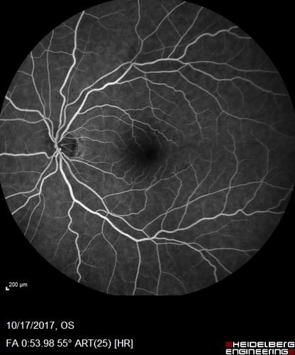 Cardiac Catheterization induced Cilioretinal Artery Occlusion - Paracentral Acute Middle Maculopathy
69 year old female with sudden vision loss on completing cardiac catheterization.  The SD OCT shows a PAMM lesion and the lesion looks gray on color imaging.  There is delayed filling of the cilioretinal artery.
