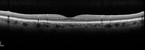 Cardiac Catheterization induced Cilioretinal Artery Occlusion - Paracentral Acute Middle Maculopathy
69 year old female with sudden vision loss on completing cardiac catheterization.  The SD OCT shows a PAMM lesion and the lesion looks gray on color imaging.  There is delayed filling of the cilioretinal artery.
