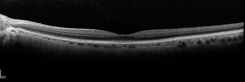 Cardiac Catheterization induced Cilioretinal Artery Occlusion - Paracentral Acute Middle Maculopathy
69 year old female with sudden vision loss on completing cardiac catheterization.  The SD OCT shows a PAMM lesion and the lesion looks gray on color imaging.  There is delayed filling of the cilioretinal artery.
