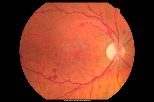 CRVO with Paracentral Acute Middle Maculopath - PAMM
56 year old woman with sudden vision loss, hemorrhages in all four quadrants.  FA shows good retinal circulation.  The OCT shows PAMM lesions in the affected eye.  Vision did improve on second visit from 20/160 to 20/60 in about a month
