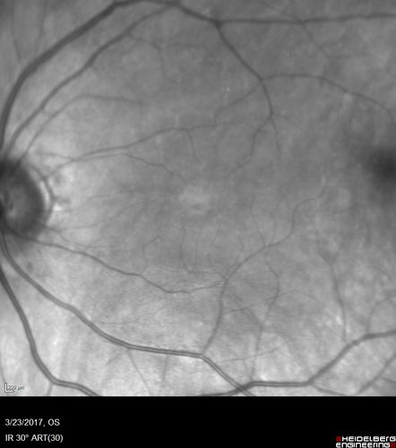 CRVO with Paracentral Acute Middle Maculopath - PAMM
56 year old woman with sudden vision loss, hemorrhages in all four quadrants.  FA shows good retinal circulation.  The OCT shows PAMM lesions in the affected eye.  Vision did improve on second visit from 20/160 to 20/60 in about a month
