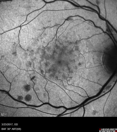 CRVO with Paracentral Acute Middle Maculopath - PAMM
56 year old woman with sudden vision loss, hemorrhages in all four quadrants.  FA shows good retinal circulation.  The OCT shows PAMM lesions in the affected eye.  Vision did improve on second visit from 20/160 to 20/60 in about a month
