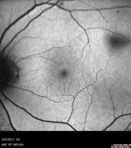 CRVO with Paracentral Acute Middle Maculopath - PAMM
56 year old woman with sudden vision loss, hemorrhages in all four quadrants.  FA shows good retinal circulation.  The OCT shows PAMM lesions in the affected eye.  Vision did improve on second visit from 20/160 to 20/60 in about a month

