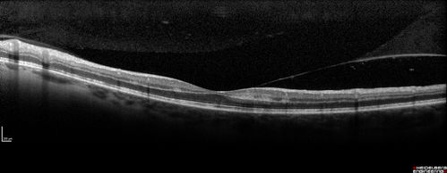 CRVO with Paracentral Acute Middle Maculopath - PAMM
56 year old woman with sudden vision loss, hemorrhages in all four quadrants.  FA shows good retinal circulation.  The OCT shows PAMM lesions in the affected eye.  Vision did improve on second visit from 20/160 to 20/60 in about a month
