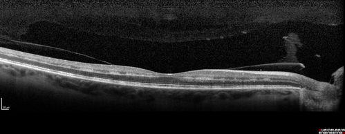 CRVO with Paracentral Acute Middle Maculopath - PAMM
56 year old woman with sudden vision loss, hemorrhages in all four quadrants.  FA shows good retinal circulation.  The OCT shows PAMM lesions in the affected eye.  Vision did improve on second visit from 20/160 to 20/60 in about a month
