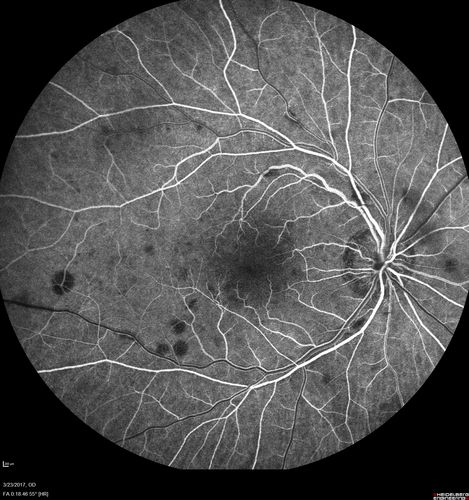 CRVO with Paracentral Acute Middle Maculopath - PAMM
56 year old woman with sudden vision loss, hemorrhages in all four quadrants.  FA shows good retinal circulation.  The OCT shows PAMM lesions in the affected eye.  Vision did improve on second visit from 20/160 to 20/60 in about a month
