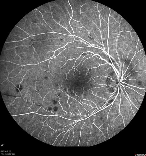CRVO with Paracentral Acute Middle Maculopath - PAMM
56 year old woman with sudden vision loss, hemorrhages in all four quadrants.  FA shows good retinal circulation.  The OCT shows PAMM lesions in the affected eye.  Vision did improve on second visit from 20/160 to 20/60 in about a month
