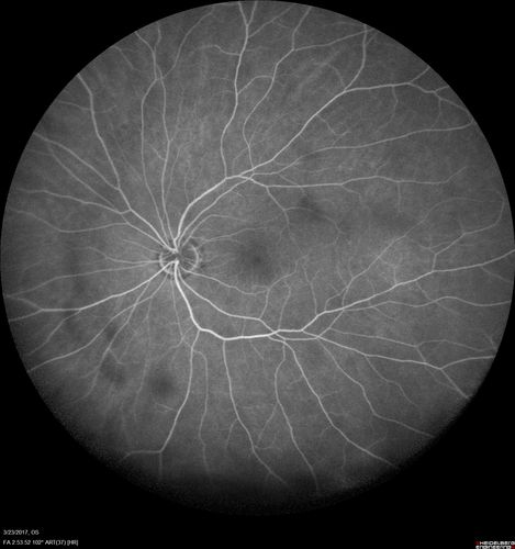 CRVO with Paracentral Acute Middle Maculopath - PAMM
56 year old woman with sudden vision loss, hemorrhages in all four quadrants.  FA shows good retinal circulation.  The OCT shows PAMM lesions in the affected eye.  Vision did improve on second visit from 20/160 to 20/60 in about a month
