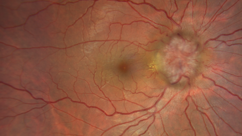 Papilledema Lateral Sinus Thrombosis
35 year old female Noticed blurred vision when waking up in the morning.  Also, vision blacks out for a few seconds when she gets up quickly. About 3 months ago she had a history of intermittent vomiting.

VA 20/20 OD, 20/25 OS

MRI normal,  MRA showed lateral sinus thrombosis.  Lupus anticoagulant was positive
