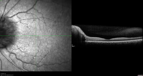 Papilledema Lateral Sinus Thrombosis
35 year old female Noticed blurred vision when waking up in the morning.  Also, vision blacks out for a few seconds when she gets up quickly. About 3 months ago she had a history of intermittent vomiting.

VA 20/20 OD, 20/25 OS

MRI normal,  MRA showed lateral sinus thrombosis.  Lupus anticoagulant was positive
