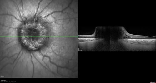 Papilledema Lateral Sinus Thrombosis
35 year old female Noticed blurred vision when waking up in the morning.  Also, vision blacks out for a few seconds when she gets up quickly. About 3 months ago she had a history of intermittent vomiting.

VA 20/20 OD, 20/25 OS

MRI normal,  MRA showed lateral sinus thrombosis.  Lupus anticoagulant was positive
