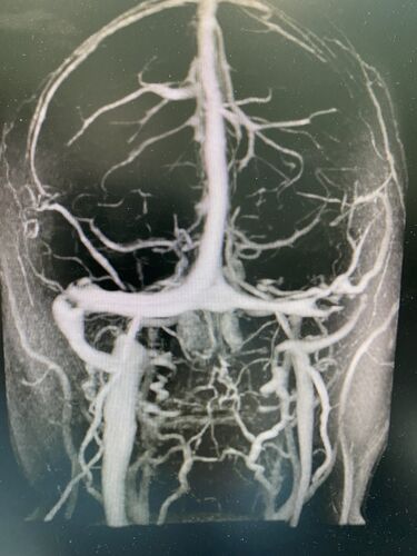 Papilledema Lateral Sinus Thrombosis
35 year old female Noticed blurred vision when waking up in the morning.  Also, vision blacks out for a few seconds when she gets up quickly. About 3 months ago she had a history of intermittent vomiting.

VA 20/20 OD, 20/25 OS

MRI normal,  MRA showed lateral sinus thrombosis.  Lupus anticoagulant was positive
