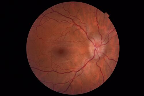Idiopathic Intracranial Hypertension - Papilledema
37 year old obese female Was on for an eye examination and a problem was noted.  Her vision is normal.  She has mild headaches which are from TMJ.
PMhx: Polycystic Ovary Syndrome (not diabetic)
Meds: Metformin, Vitamin D, Spironolactone
VA 20/12 OD, 20/16 OS
Opening ICP on spinal tap was 30 CM water.
