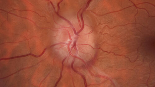 Idiopathic Intracranial Hypertension - Papilledema
37 year old obese female Was on for an eye examination and a problem was noted.  Her vision is normal.  She has mild headaches which are from TMJ.
PMhx: Polycystic Ovary Syndrome (not diabetic)
Meds: Metformin, Vitamin D, Spironolactone
VA 20/12 OD, 20/16 OS
Opening ICP on spinal tap was 30 CM water.

