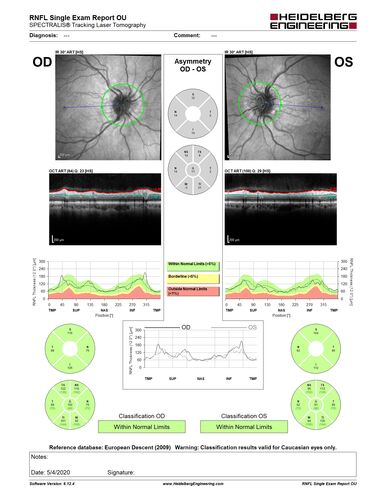 Idiopathic Intracranial Hypertension - Papilledema
37 year old obese female Was on for an eye examination and a problem was noted.  Her vision is normal.  She has mild headaches which are from TMJ.
PMhx: Polycystic Ovary Syndrome (not diabetic)
Meds: Metformin, Vitamin D, Spironolactone
VA 20/12 OD, 20/16 OS
Opening ICP on spinal tap was 30 CM water.

