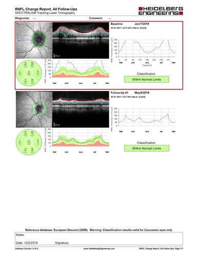 Idiopathic Intracranial Hypertension - Papilledema
37 year old obese female Was on for an eye examination and a problem was noted.  Her vision is normal.  She has mild headaches which are from TMJ.
PMhx: Polycystic Ovary Syndrome (not diabetic)
Meds: Metformin, Vitamin D, Spironolactone
VA 20/12 OD, 20/16 OS
Opening ICP on spinal tap was 30 CM water.
