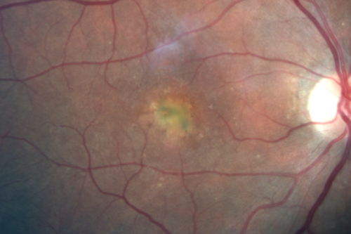Adult Vitelliform Macular Dystrophy - Pattern Dystrophy
