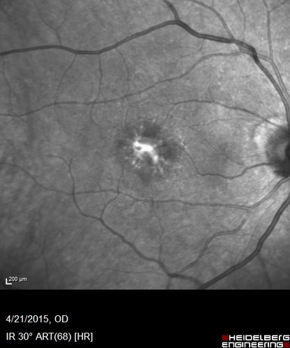 Adult Vitelliform Macular Dystrophy - Pattern Dystrophy
