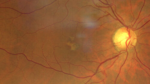 Pattern Dystrophy - PHPR2 Gene
57 year old man- VA 20/25 OD, 20/20 OS - Many family members have retinitis pigmentosa

