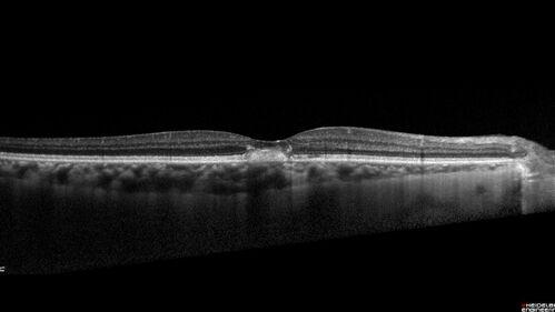 Pattern Dystrophy - PHPR2 Gene
57 year old man- VA 20/25 OD, 20/20 OS - Many family members have retinitis pigmentosa
