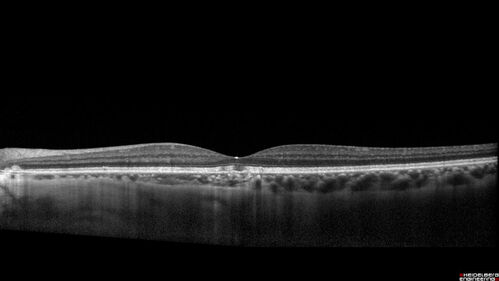 Pattern Dystrophy - PHPR2 Gene
57 year old man- VA 20/25 OD, 20/20 OS - Many family members have retinitis pigmentosa
