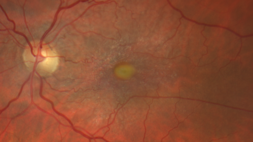 Adult Pseudovitelliform Macular Dystrophy
89 year old female states dark smudge on ceiling during night time came and went.  Decreased vision in the left eye
VA OD: Dcc20/32
VA OS: Dcc20/63
