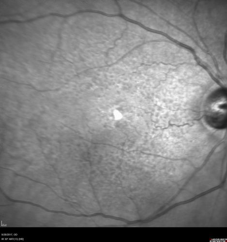 Adult Pseudovitelliform Macular Dystrophy
89 year old female states dark smudge on ceiling during night time came and went.  Decreased vision in the left eye
VA OD: Dcc20/32
VA OS: Dcc20/63
