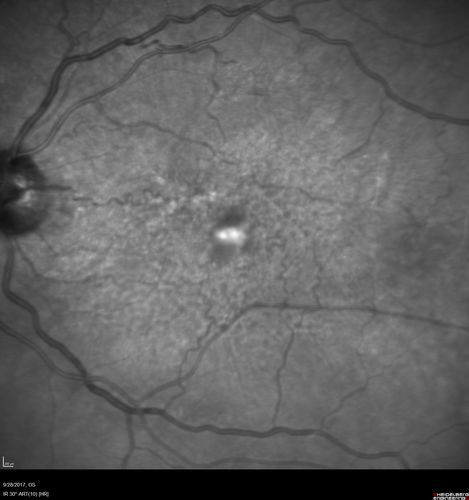 Adult Pseudovitelliform Macular Dystrophy
89 year old female states dark smudge on ceiling during night time came and went.  Decreased vision in the left eye
VA OD: Dcc20/32
VA OS: Dcc20/63
