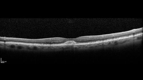 Adult Pseudovitelliform Macular Dystrophy
89 year old female states dark smudge on ceiling during night time came and went.  Decreased vision in the left eye
VA OD: Dcc20/32
VA OS: Dcc20/63

