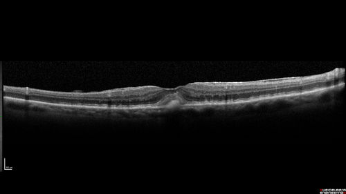Adult Pseudovitelliform Macular Dystrophy
89 year old female states dark smudge on ceiling during night time came and went.  Decreased vision in the left eye
VA OD: Dcc20/32
VA OS: Dcc20/63
