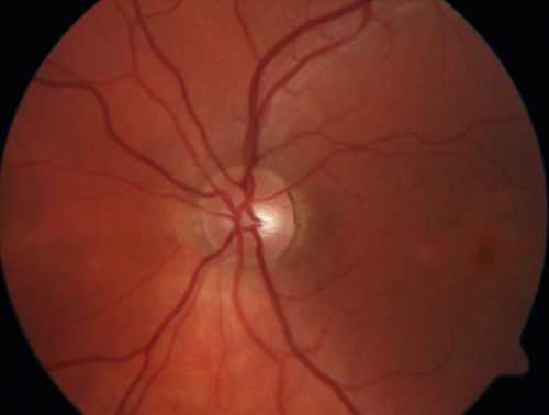 Pattern Dystrophy - Probably Early Butterfly
33 year old with normal vision and no visual complaints - normal color vision
