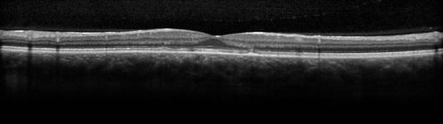 Pattern Dystrophy - Probably Early Butterfly
33 year old with normal vision and no visual complaints - normal color vision
