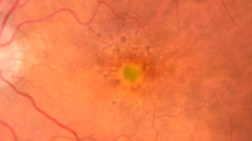 Pattern Dystrophy - Foveal Atrophy
73 year old female with vision loss - looks like macular hole
