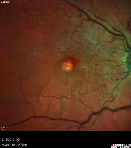 Pattern Dystrophy - Foveal Atrophy
73 year old female with vision loss - looks like macular hole
