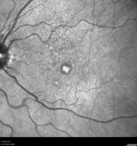 Pattern Dystrophy - Foveal Atrophy
73 year old female with vision loss - looks like macular hole
