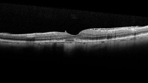 Pattern Dystrophy - Foveal Atrophy
73 year old female with vision loss - looks like macular hole
