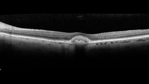 Pattern Dystrophy - Foveal Atrophy
73 year old female with vision loss - looks like macular hole

