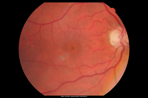 Pattern dystrophy with progressive foveal atrophy left eye
72 year old man.  Vision in the left eye is 20/80.  It declined to 5/200 over about 3 years.
