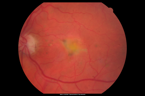 Pattern dystrophy with progressive foveal atrophy left eye
72 year old man.  Vision in the left eye is 20/80.  It declined to 5/200 over about 3 years.
