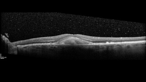 Pattern dystrophy with progressive foveal atrophy left eye
72 year old man.  Vision in the left eye is 20/80.  It declined to 5/200 over about 3 years.
