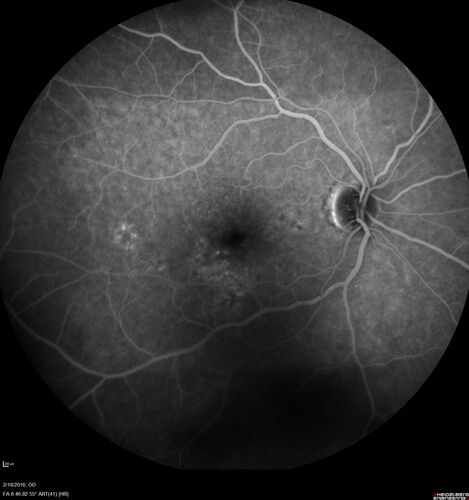 Pattern dystrophy with progressive foveal atrophy left eye
72 year old man.  Vision in the left eye is 20/80.  It declined to 5/200 over about 3 years.
